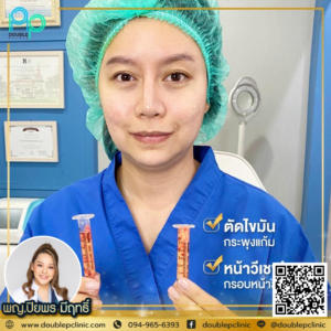 ตัดไขมันกระพุ้งแก้ม