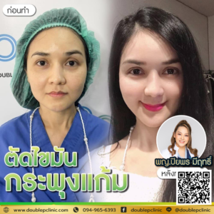 ตัดไขมันกระพุ้งแก้ม