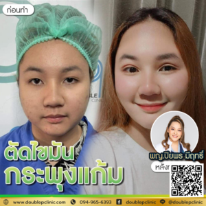 ตัดไขมันกระพุ้งแก้ม