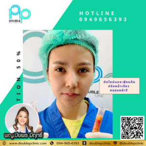 ตัดไขมันกระพุ้งแก้ม