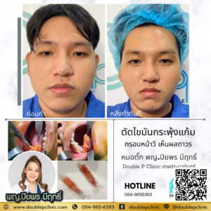 ตัดไขมันกระพุ้งแก้ม