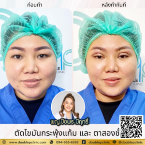 ตัดไขมันกระพุ้งแก้ม