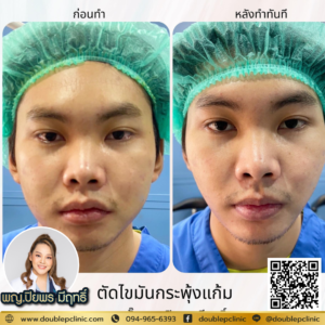 ตัดไขมันกระพุ้งแก้ม