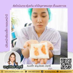 ตัดไขมันกระพุ้งแก้ม