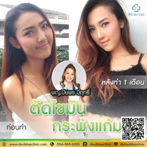 ตัดไขมันกระพุ้งแก้ม