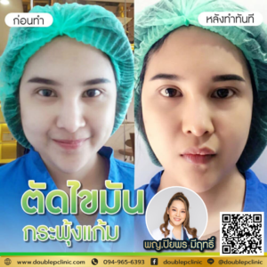 ตัดไขมันกระพุ้งแก้ม