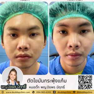ตัดไขมันกระพุ้งแก้ม