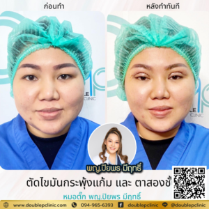ตัดไขมันกระพุ้งแก้ม