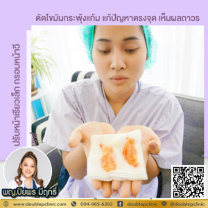 ตัดไขมันกระพุ้งแก้ม
