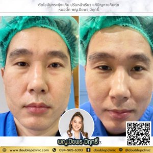 ตัดไขมันกระพุ้งแก้ม