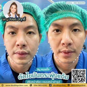 ตัดไขมันกระพุ้งแก้ม