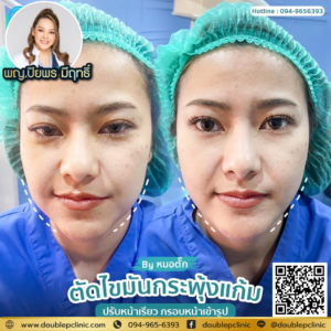 ตัดไขมันกระพุ้งแก้ม