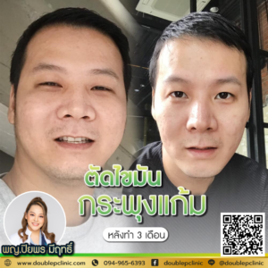 ตัดไขมันกระพุ้งแก้ม
