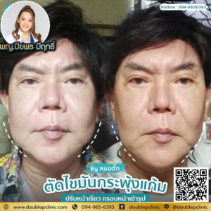 ตัดไขมันกระพุ้งแก้ม
