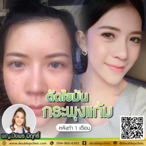 ตัดไขมันกระพุ้งแก้ม