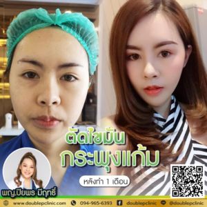 ตัดไขมันกระพุ้งแก้ม