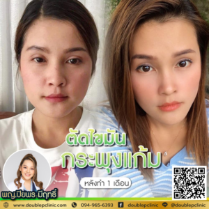 ตัดไขมันกระพุ้งแก้ม