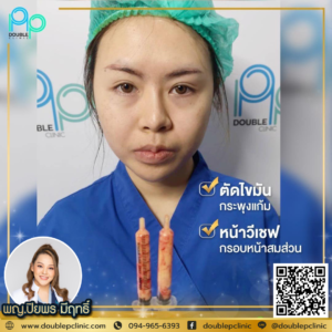 ตัดไขมันกระพุ้งแก้ม