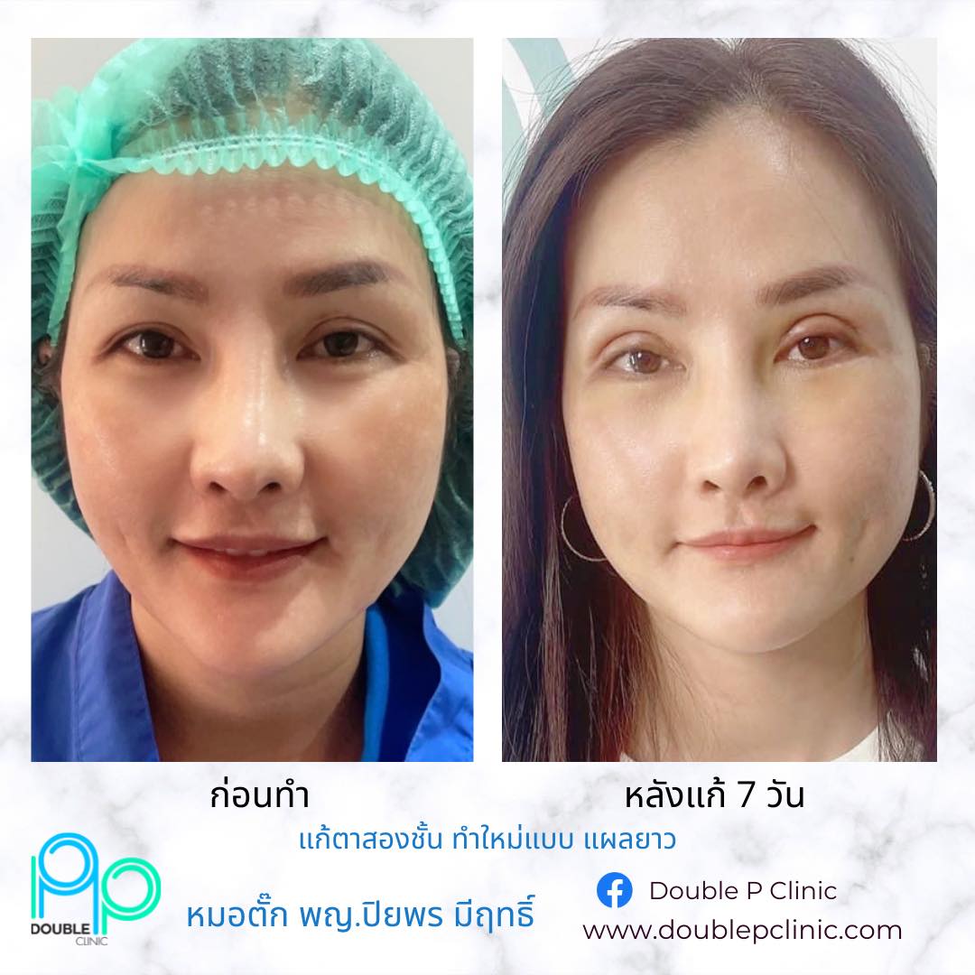 แก้ตาสองชั้น