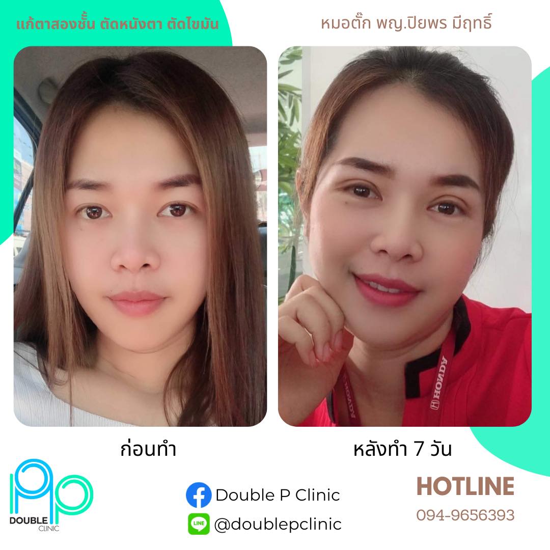 แก้ตาสองชั้น
