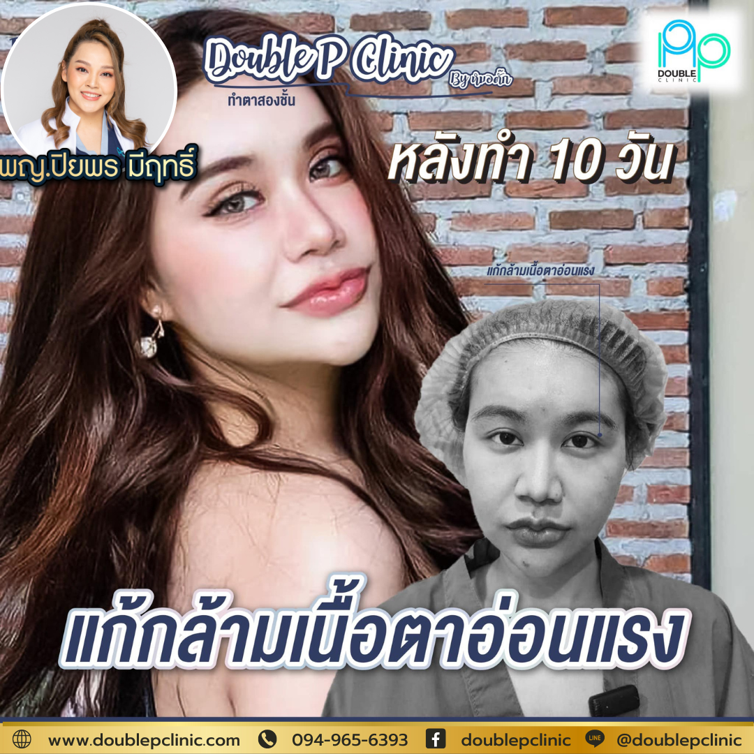 แก้ตาสองชั้น