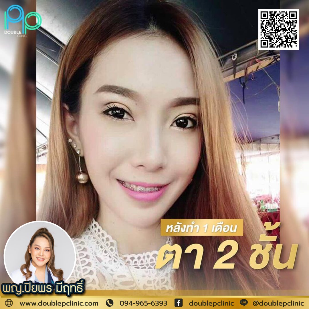 ตาสองชั้น แผลสั้น