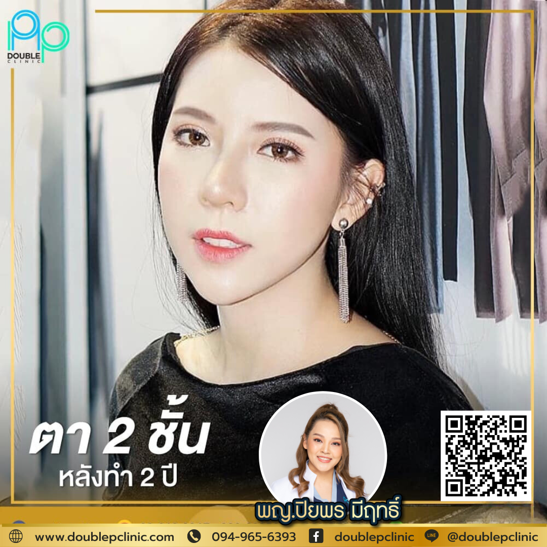 ตาสองชั้น แผลสั้น