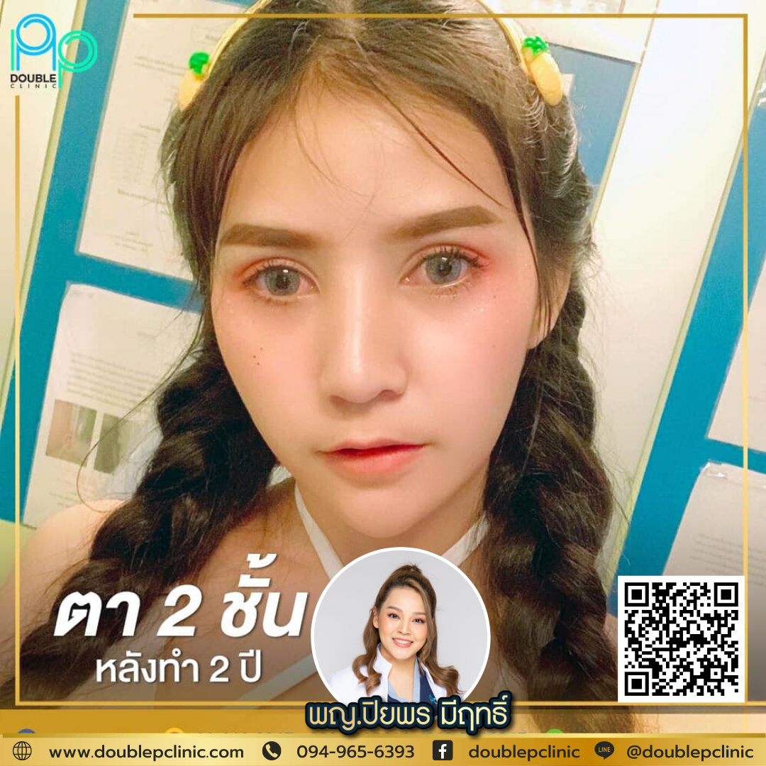 ตาสองชั้น แผลสั้น