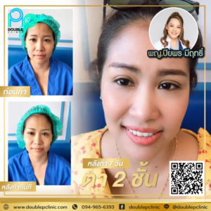 ตาสองชั้น แผลสั้น
