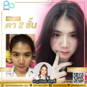 ตาสองชั้น แผลสั้น