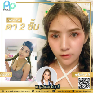 ตาสองชั้น แผลสั้น