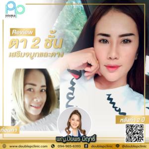 ตาสองชั้น แผลสั้น