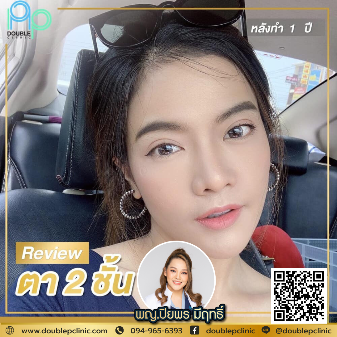 ตาสองชั้น แผลสั้น