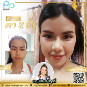 ตาสองชั้น แผลสั้น