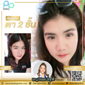 ตาสองชั้น แผลสั้น