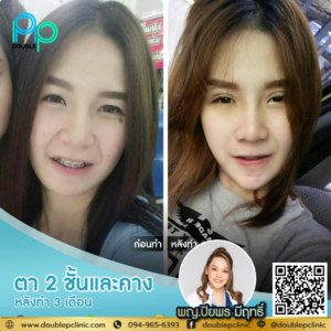 ตาสองชั้น แผลสั้น