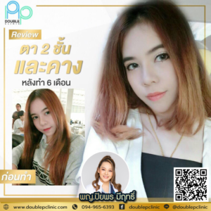 ตาสองชั้น แผลสั้น