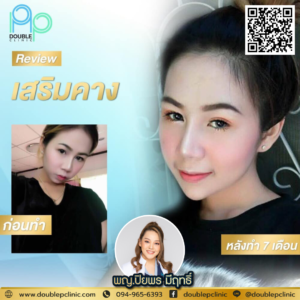เสริมคาง แผลใน
