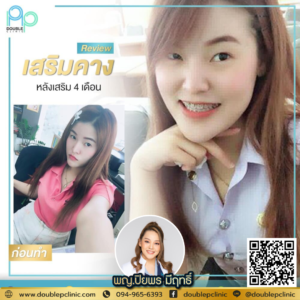 เสริมคาง แผลใน