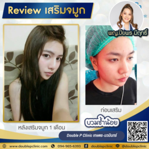 เสริมจมูก