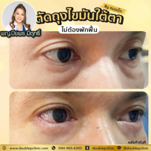 ตัดไขมันใต้ตา