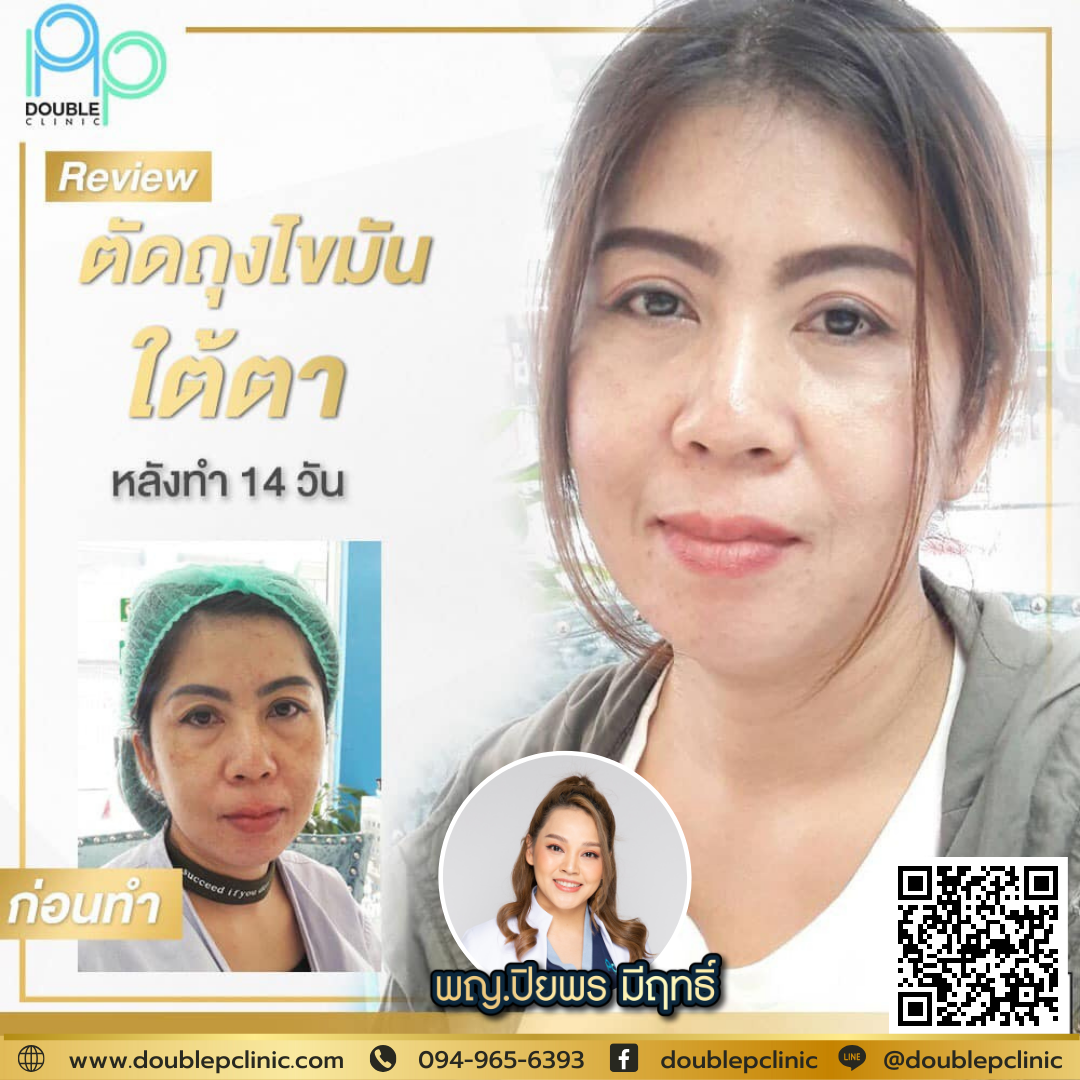 ตัดไขมันใต้ตา