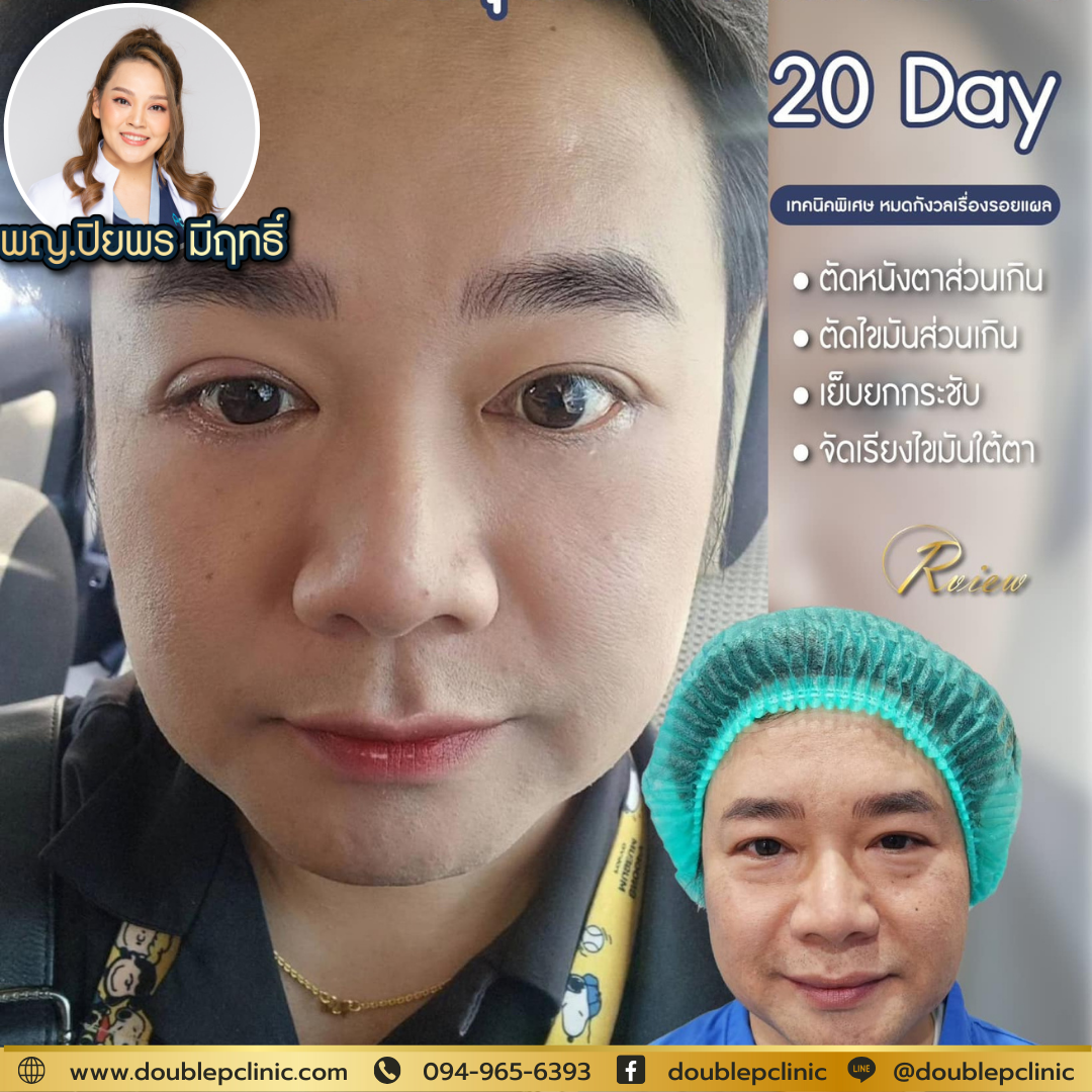 ตัดไขมันใต้ตา