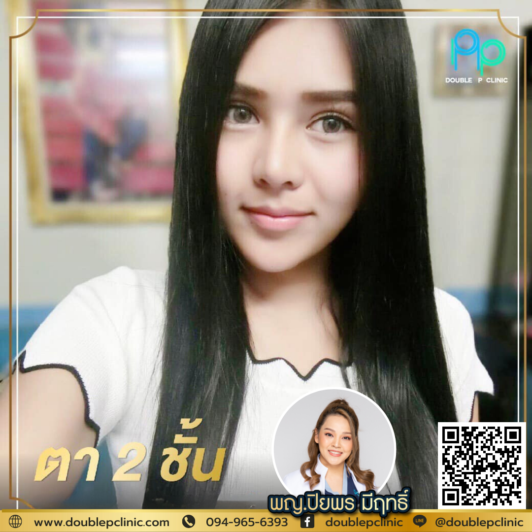 ตาสองชั้น แผลยาว