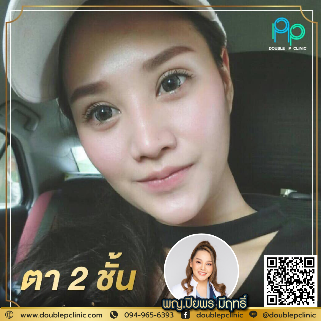 ตาสองชั้น แผลยาว