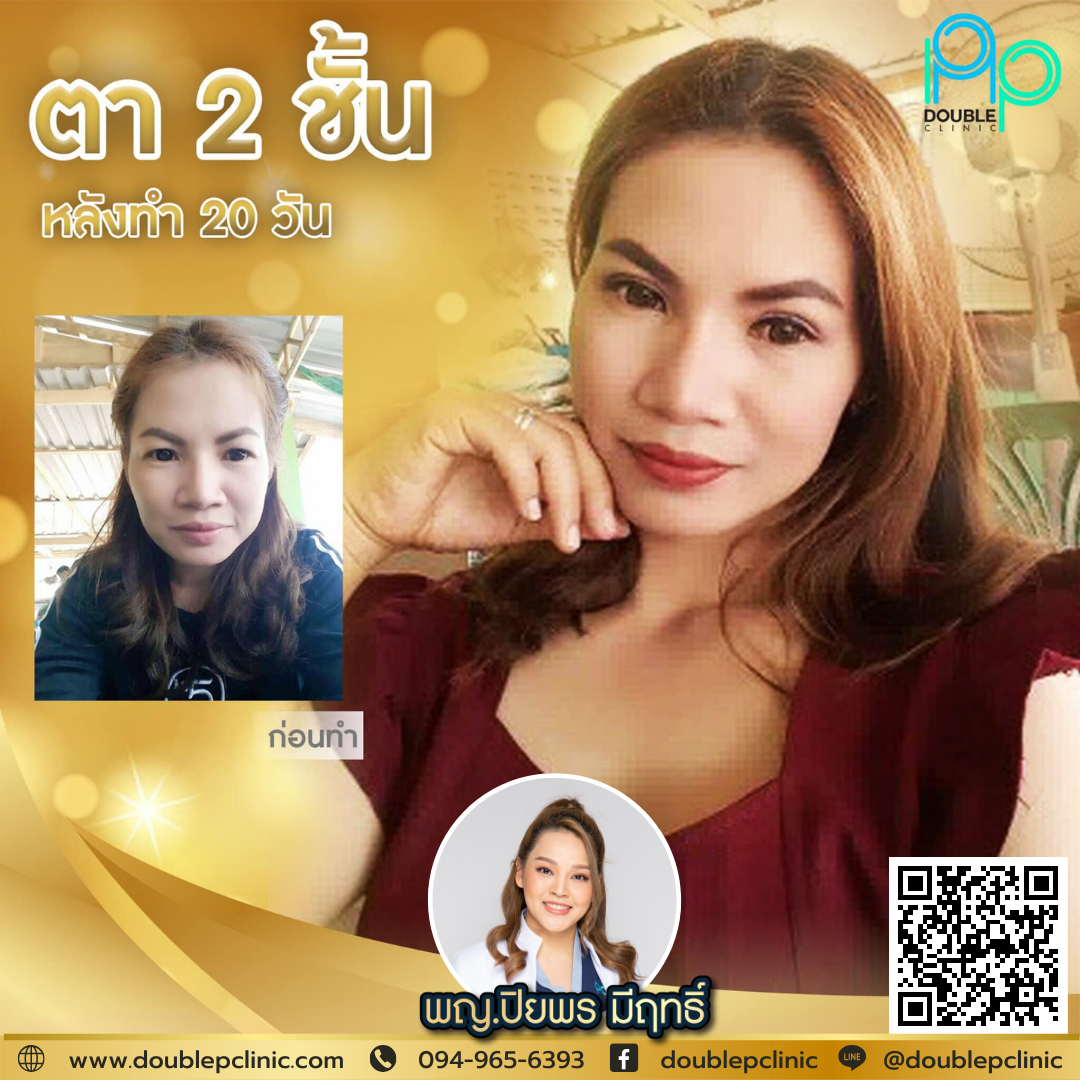 ตาสองชั้น แผลยาว