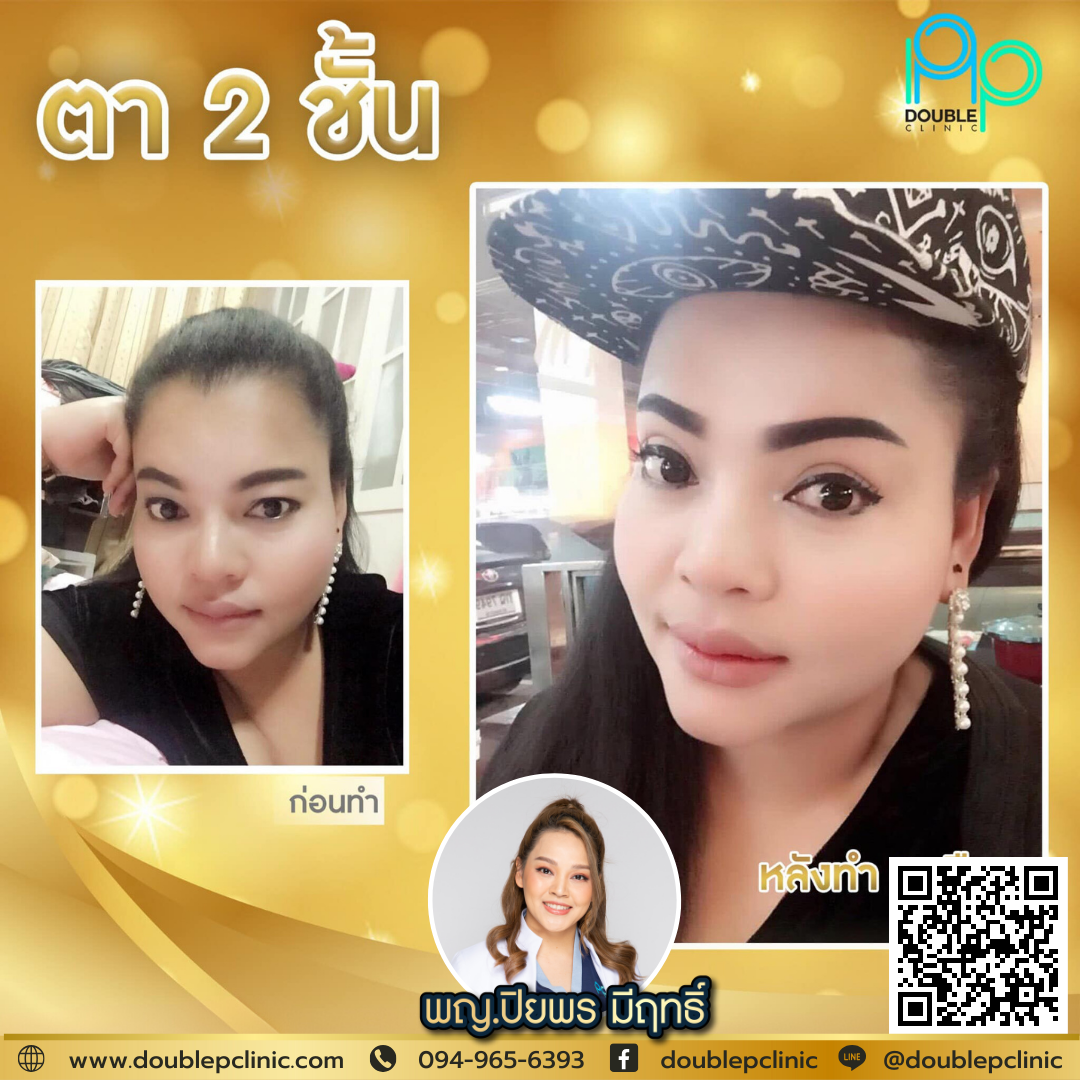 ตาสองชั้น แผลยาว