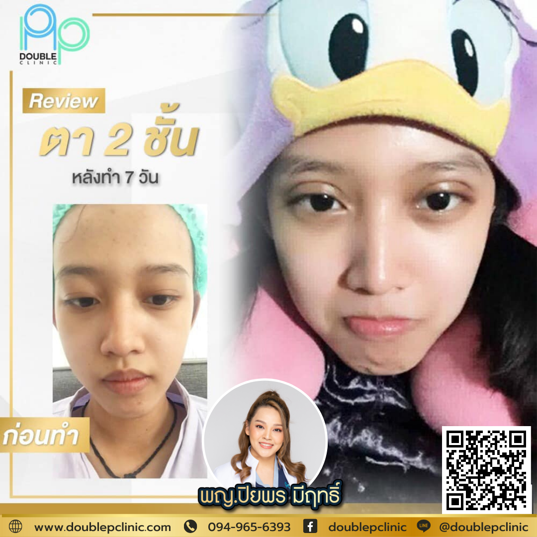 ตาสองชั้น แผลยาว
