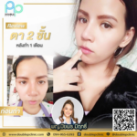 ตาสองชั้น แผลยาว