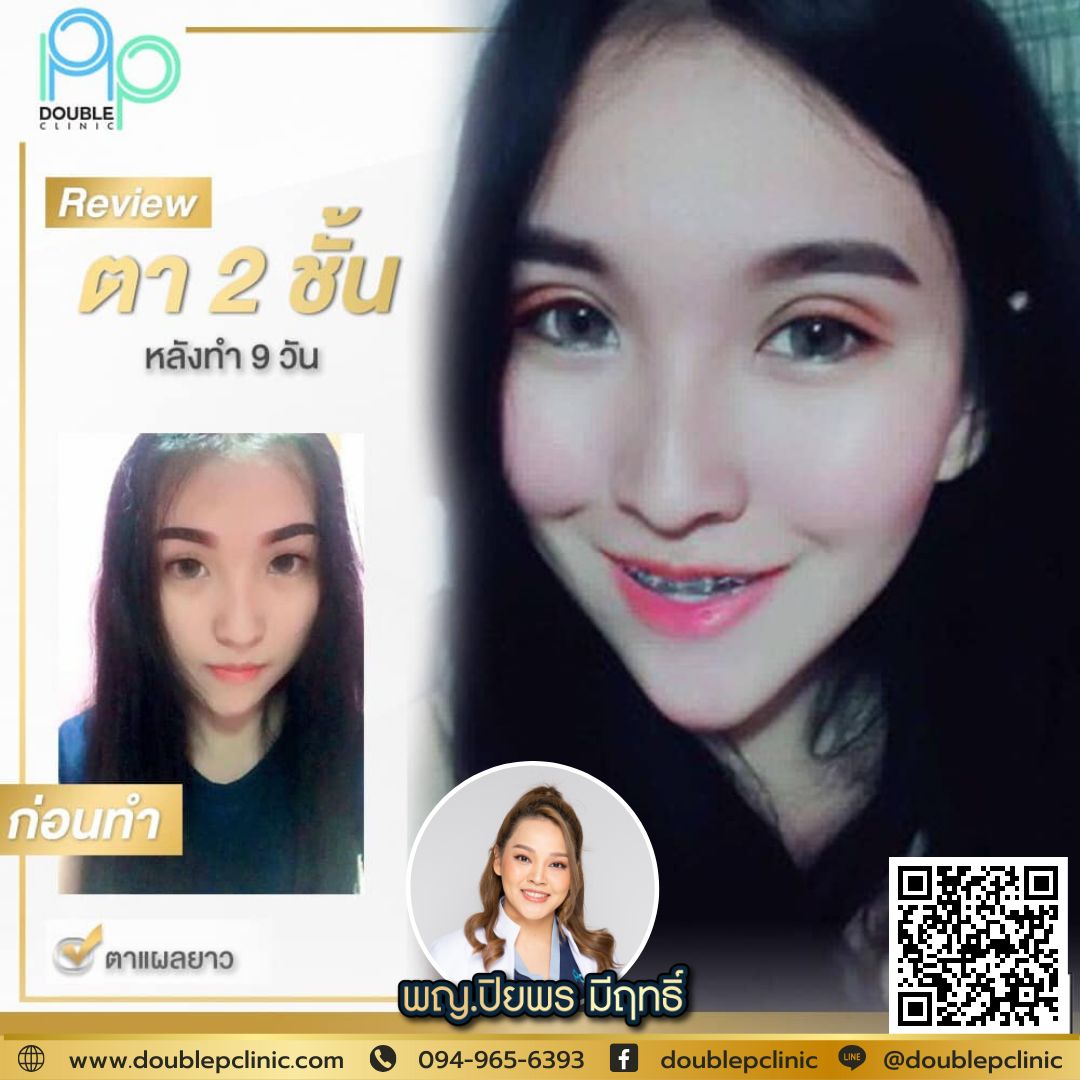 ตาสองชั้น แผลยาว